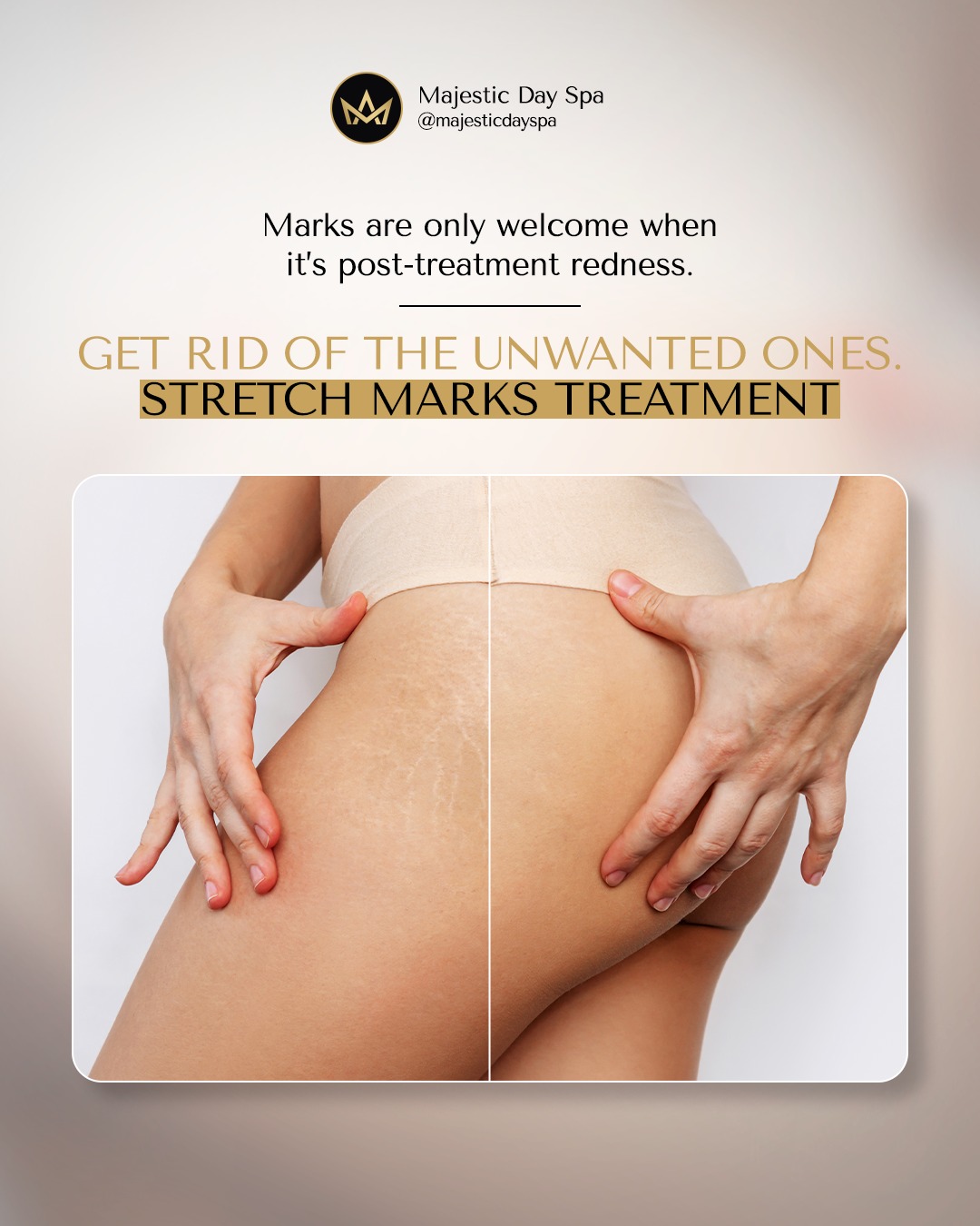 Some marks are a sign of progress — a glowing flush after a perfect treatment, the warmth of circulation, the freshness of renewal.
But stretch marks? The ones you didn’t choose? You don’t have to live with those if you don’t want to.
At Majestic Day Spa, we offer advanced Stretch Marks Treatment designed to fade and smooth those lines while preserving the beauty of your skin. Using powerful technology and techniques focused on collagen stimulation and skin regeneration, we help soften the appearance of stretch marks and bring back confidence to every inch of you.
You deserve to feel proud of your skin. All of it. From every angle.
📅 Book your personalized stretch mark treatment today — and keep only the marks worth celebrating.
